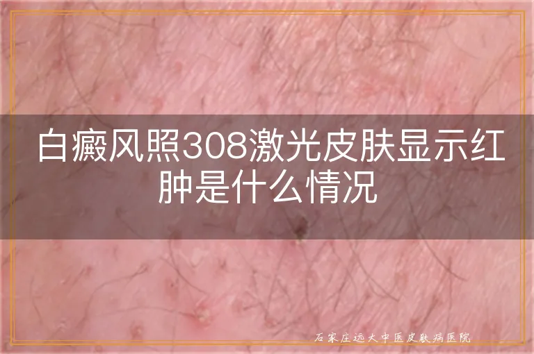 白癜风照308激光皮肤显示红肿是什么情况