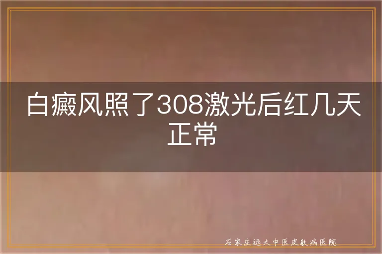 白癜风照了308激光后红几天正常