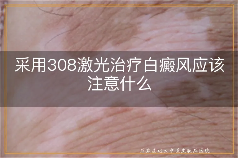 采用308激光治疗白癜风应该注意什么