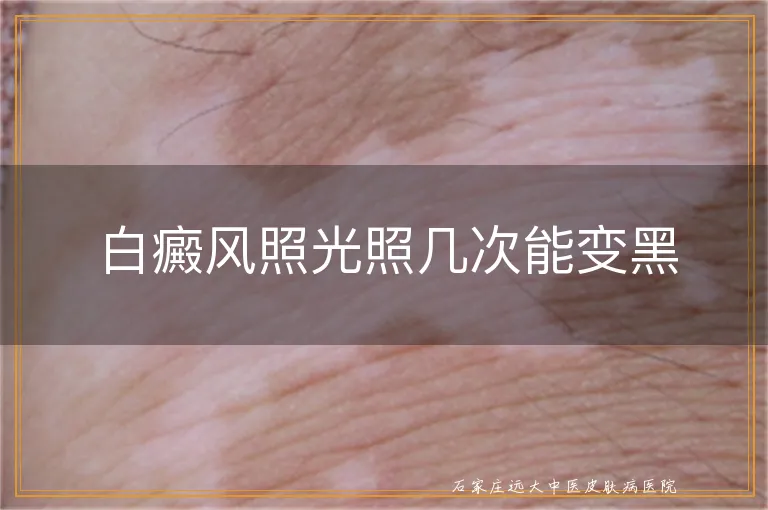 白癜风照光照几次能变黑