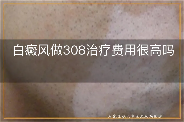 白癜风做308治疗费用很高吗