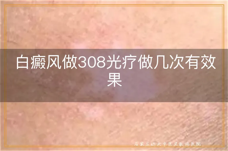 白癜风做308光疗做几次有效果