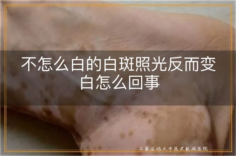 不怎么白的白斑照光反而变白怎么回事