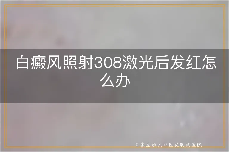 白癜风照射308激光后发红怎么办