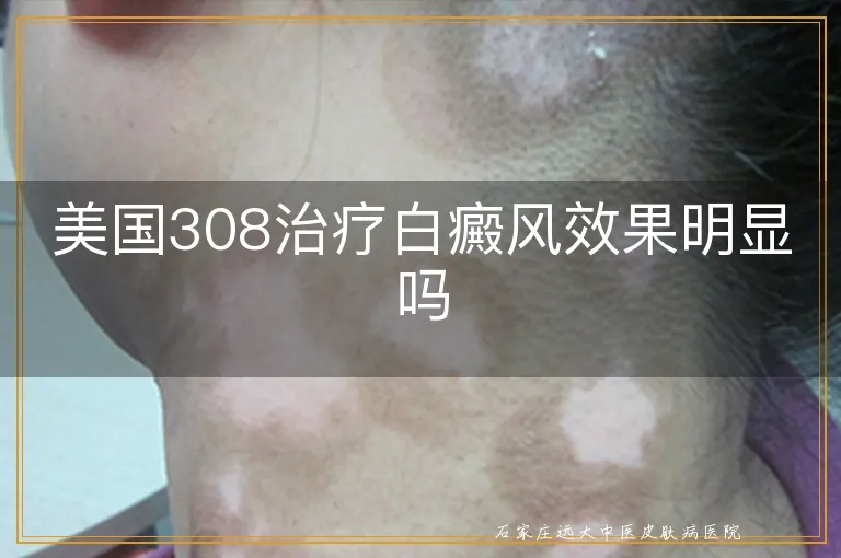 美国308治疗白癜风效果明显吗