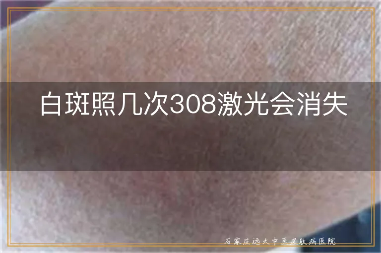 白斑照几次308激光会消失