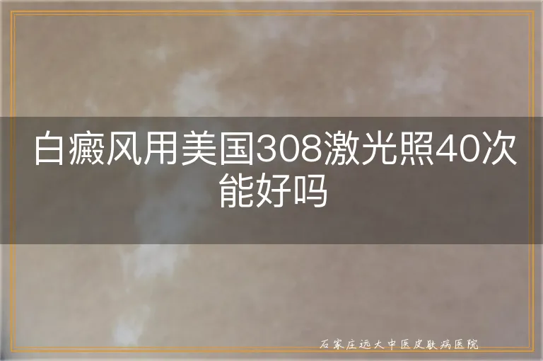 白癜风用美国308激光照40次能好吗