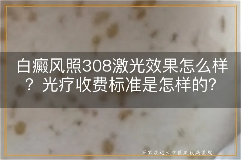 白癜风照308激光效果怎么样？光疗收费标准是怎样的？