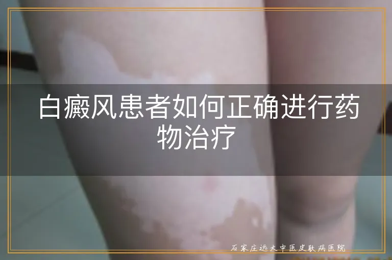 白癜风患者如何正确进行药物治疗