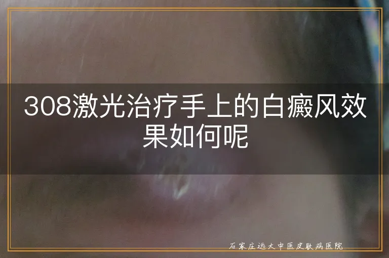 308激光治疗手上的白癜风效果如何呢