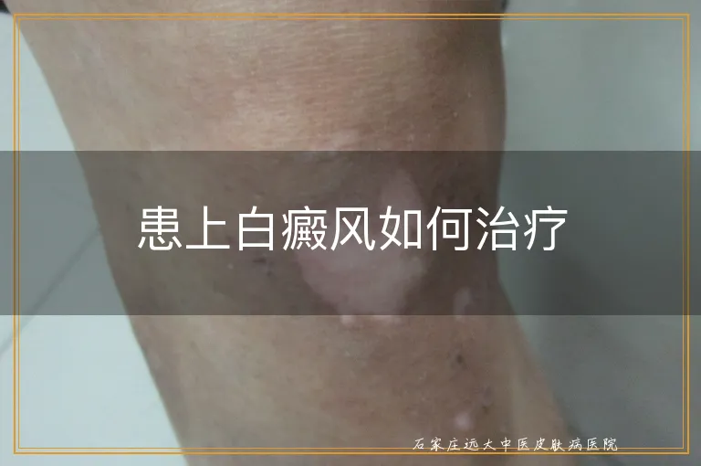 患上白癜风如何治疗