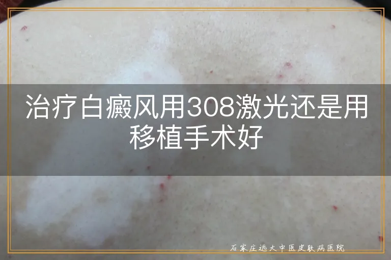 治疗白癜风用308激光还是用移植手术好