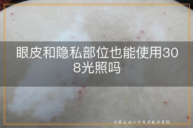 眼皮和隐私部位也能使用308光照吗