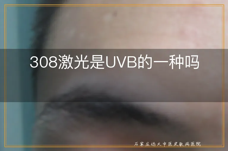 308激光是UVB的一种吗