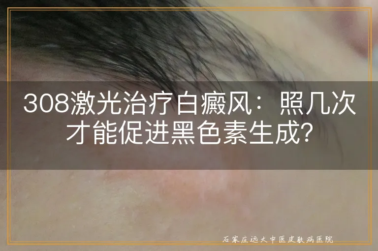 308激光治疗白癜风：照几次才能促进黑色素生成？