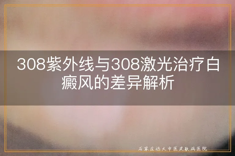 308紫外线与308激光治疗白癜风的差异解析