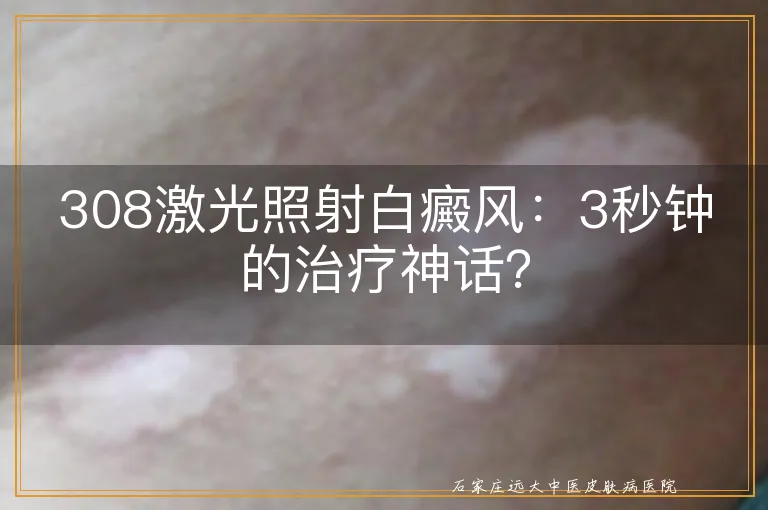 308激光照射白癜风：3秒钟的治疗神话？