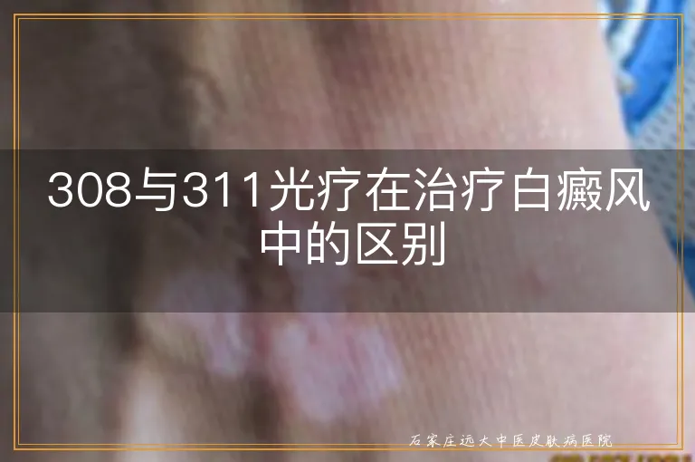 308与311光疗在治疗白癜风中的区别