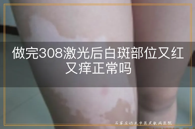 做完308激光后白斑部位又红又痒正常吗