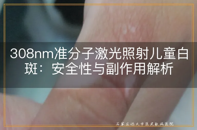 308nm准分子激光照射儿童白斑：安全性与副作用解析