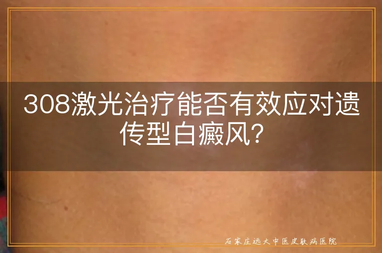 308激光治疗能否有效应对遗传型白癜风？