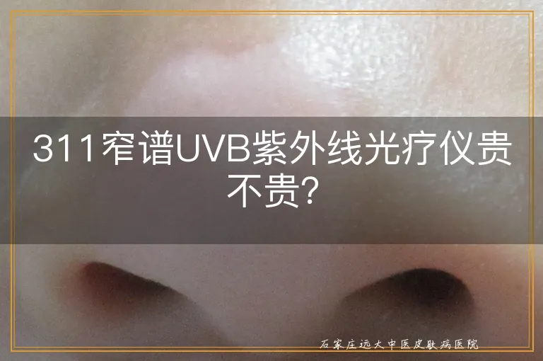 311窄谱UVB紫外线光疗仪贵不贵？