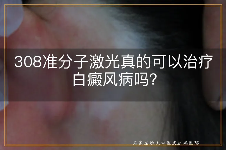 308准分子激光真的可以治疗白癜风病吗？