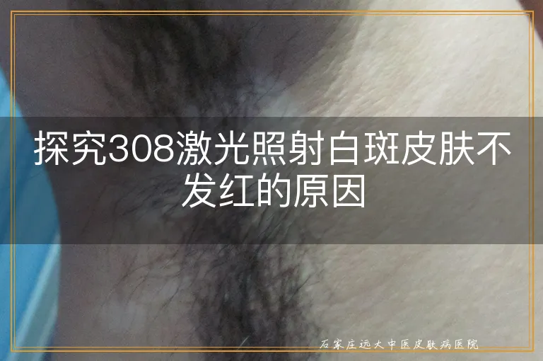 探究308激光照射白斑皮肤不发红的原因