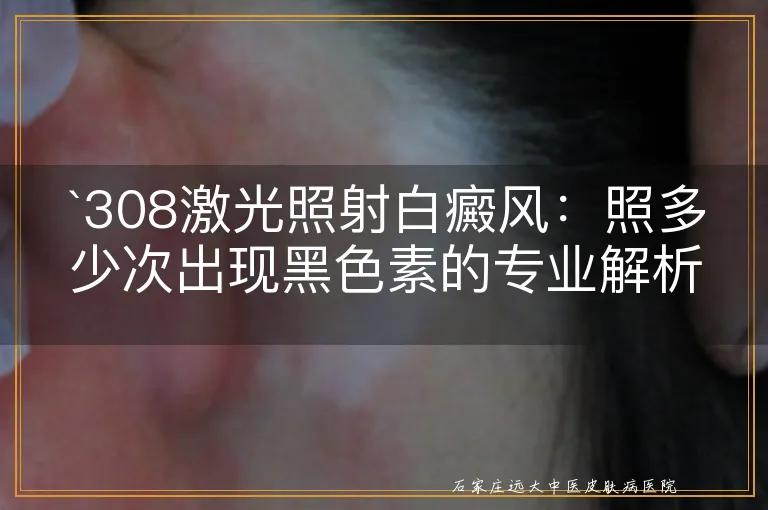 `308激光照射白癜风：照多少次出现黑色素的专业解析`