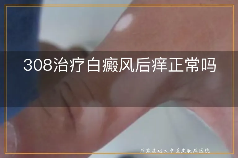 308治疗白癜风后痒正常吗