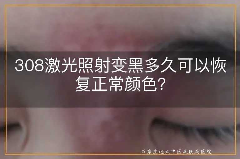 308激光照射变黑多久可以恢复正常颜色？