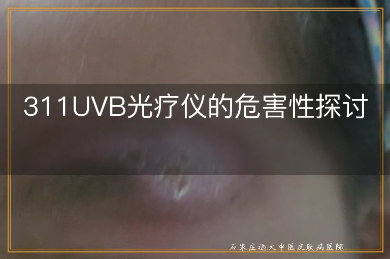 311UVB光疗仪的危害性探讨