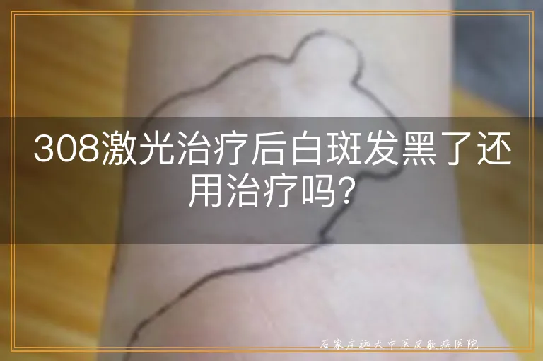 308激光治疗后白斑发黑了还用治疗吗？