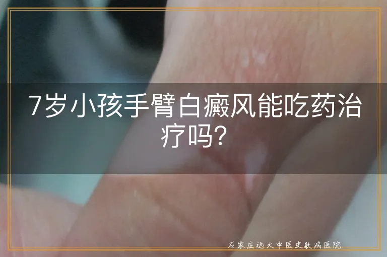 7岁小孩手臂白癜风能吃药治疗吗？