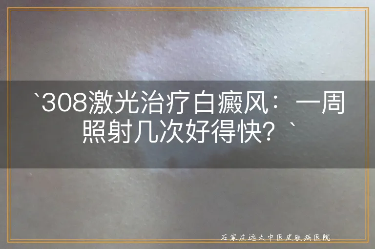 308激光治疗白癜风：一周照射几次好得快？