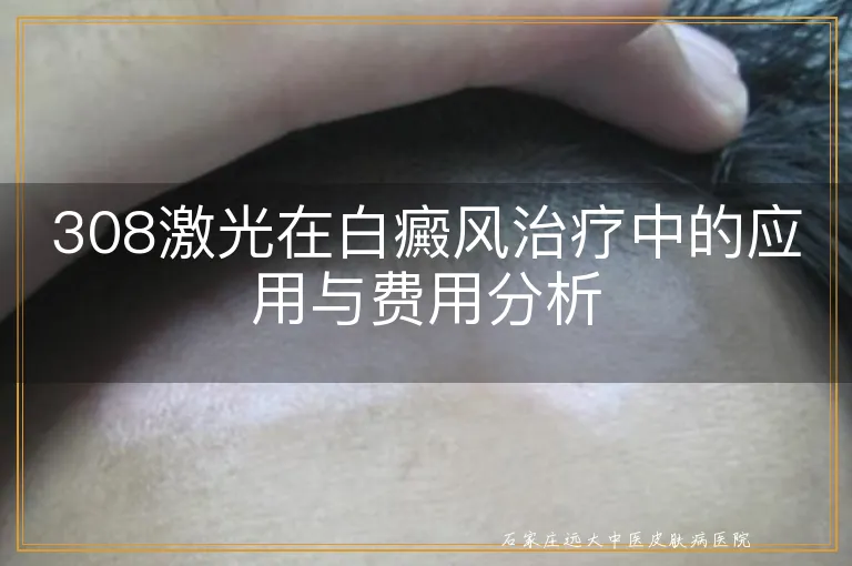 308激光在白癜风治疗中的应用与费用分析