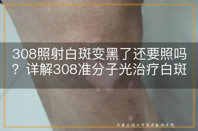 308照射白斑变黑了还要照吗？详解308准分子光治疗白斑的过程与后续处理