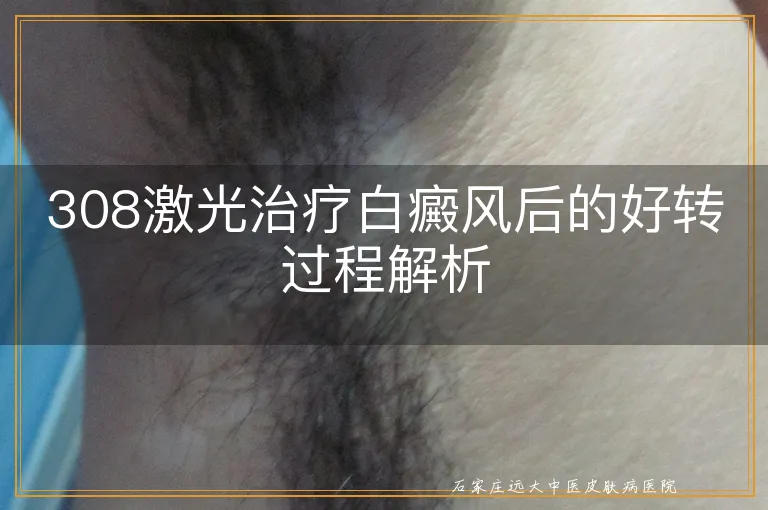 308激光治疗白癜风后的好转过程解析