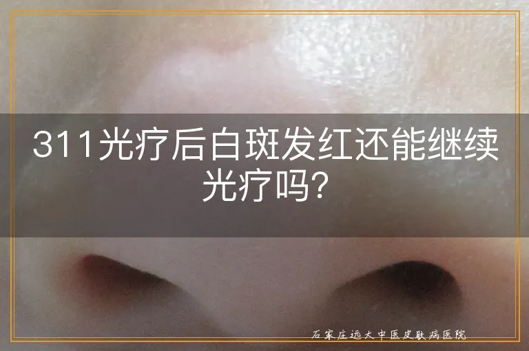 311光疗后白斑发红还能继续光疗吗？