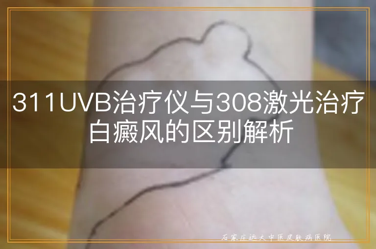 311UVB治疗仪与308激光治疗白癜风的区别解析