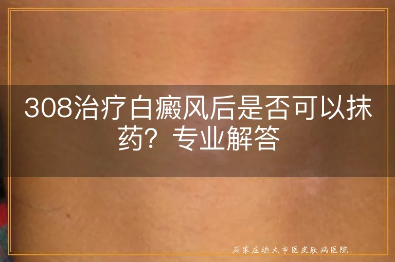 308治疗白癜风后是否可以抹药？专业解答