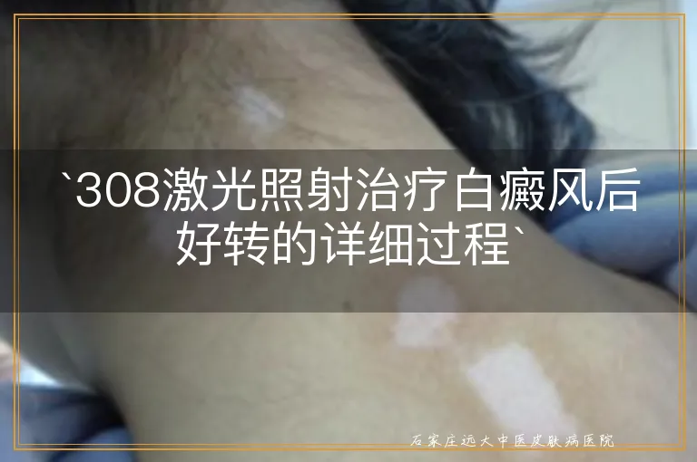 `308激光照射治疗白癜风后好转的详细过程`