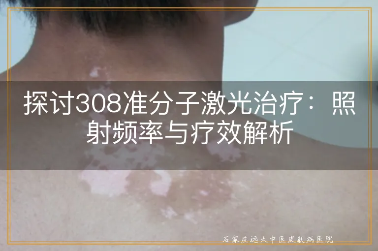 探讨308准分子激光治疗：照射频率与疗效解析