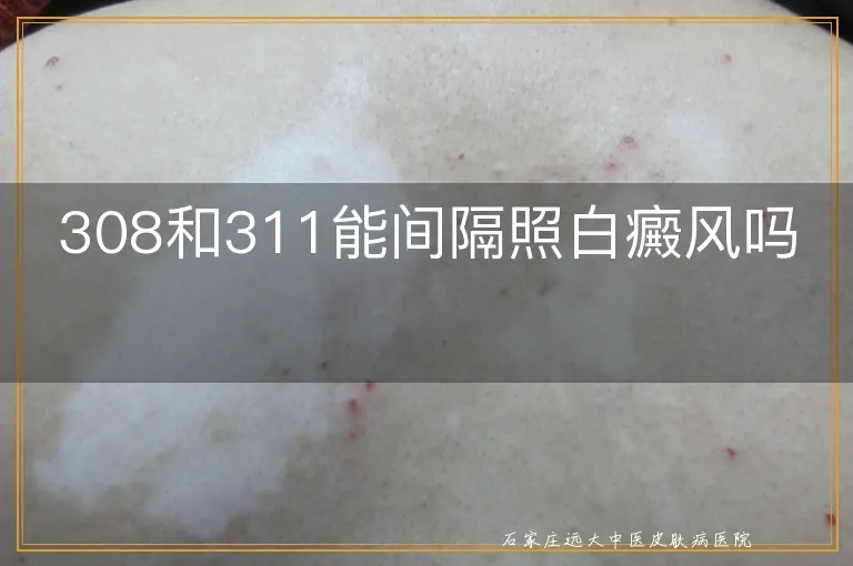 308和311能间隔照白癜风吗