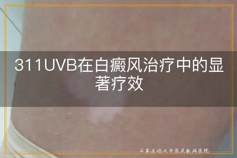 311UVB在白癜风治疗中的显著疗效