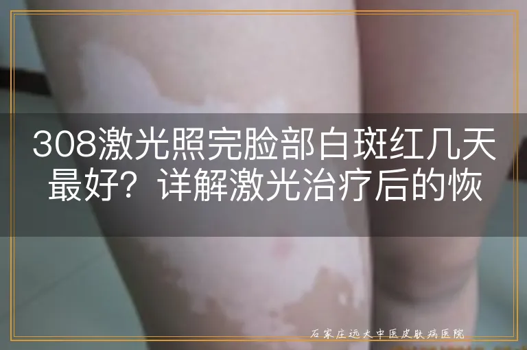 308激光照完脸部白斑红几天最好？详解激光治疗后的恢复过程