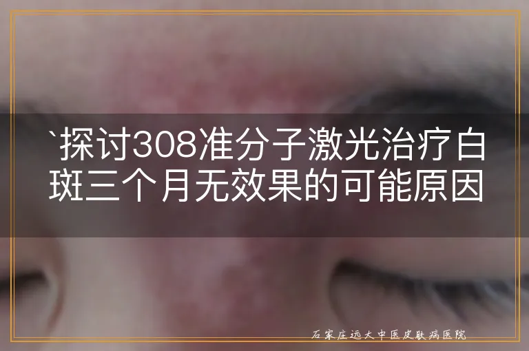 `探讨308准分子激光治疗白斑三个月无效果的可能原因`