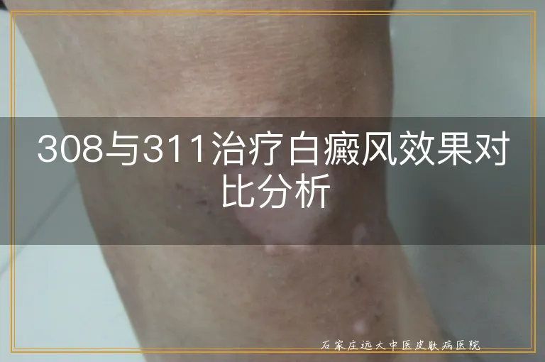 308与311治疗白癜风效果对比分析