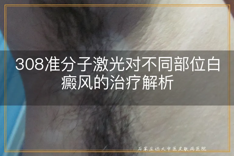 308准分子激光对不同部位白癜风的治疗解析