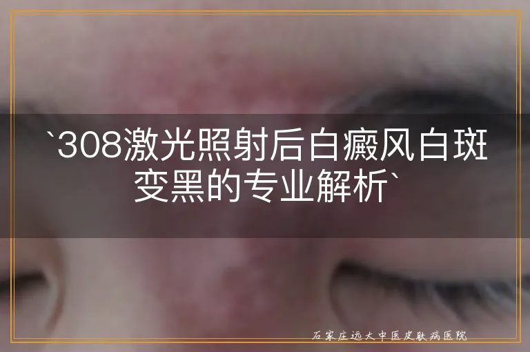 `308激光照射后白癜风白斑变黑的专业解析`